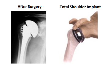 Total Shoulder Replacement Surgery Implant