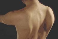 winged scapula, dyskinesis photo