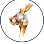 Bone and Joint Specialists, Arthritis in Hip Photo