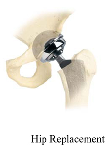 Total Hip Replacement