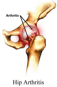 Bone and Joint Specialists, Arthritis in Hip Photo