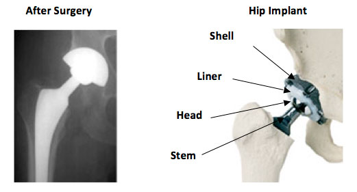 Total Hip Replacement Implant diagram and x-ray