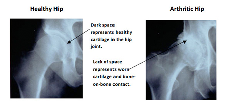 Total Hip Replacement Arthritis Xray