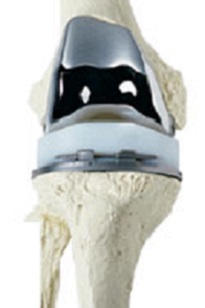 Total Knee Replacement, Total Arthroplasty, Knee Implant