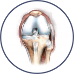 Bone and Joint Specialists, Arthritis in Knee Photo