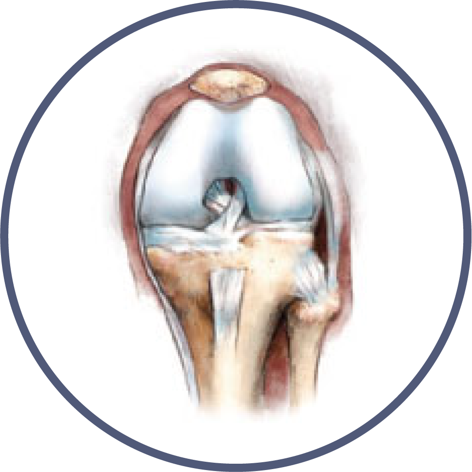 Knee Orthopedic Library Bone and Joint Specialists, Arthritis in Knee Photo