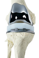 Total Knee Replacement, Total Arthroplasty, Knee Implant
