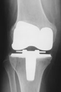 After Total Knee Replacement Surgery x-ray