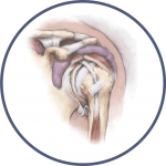 Bone and Joint Specialists, Arthritis in Shoulder Photo