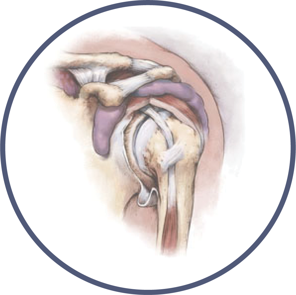 Shoulder Orthopedic Library Bone and Joint Specialists, Arthritis in Shoulder Photo