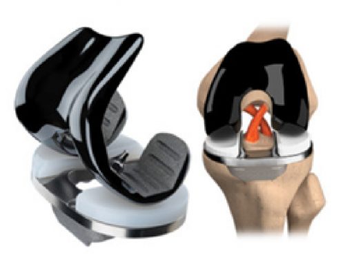 JOURNEY II Active Knee System